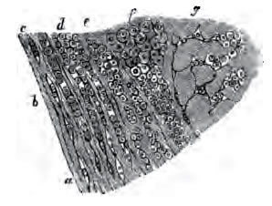 Cancer cells from Cellular Pathology by Rudolf Virchow